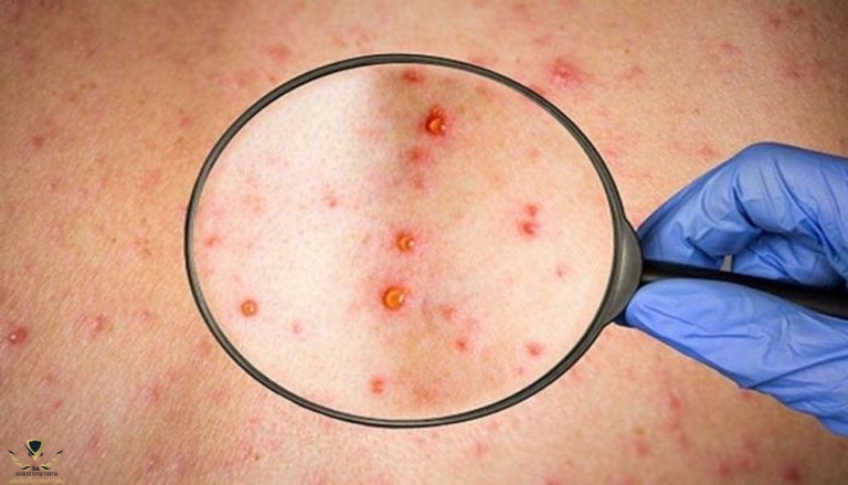 127-124722-monkeypox-disease-rare-virus_700x400.jpg