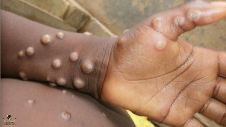 127-124723-monkeypox-disease-rare-virus-2.jpeg