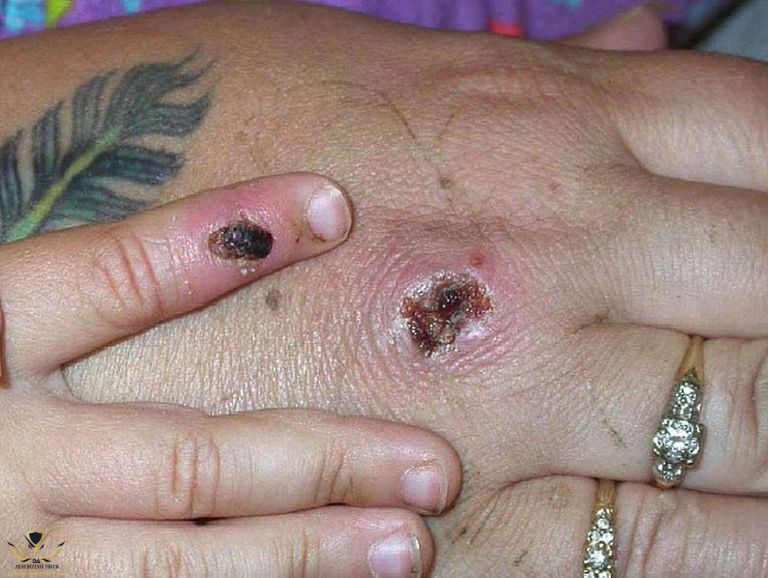 127-124724-monkeypox-disease-rare-virus-5.jpeg