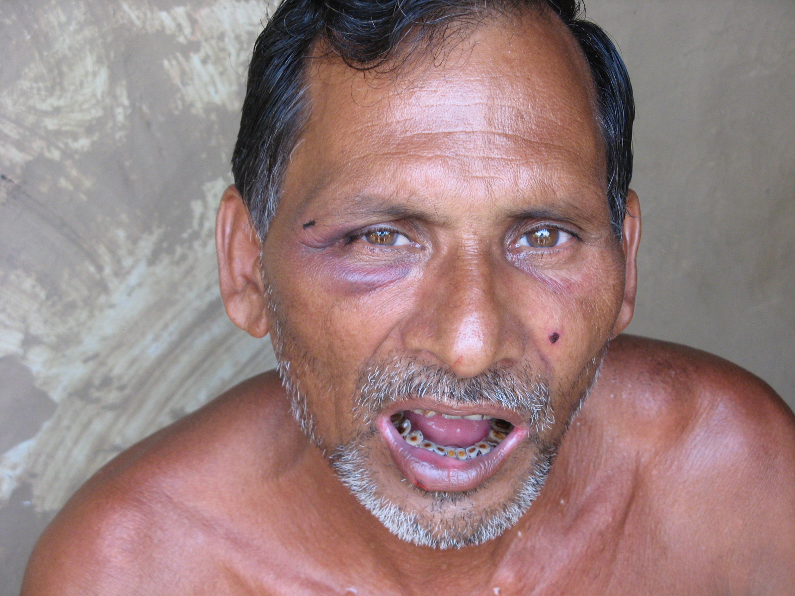 bharat-bardhan-who-was-hit-by-a-rubber-bullet-and-a-shotgun-pellet-on-his-face.JPG