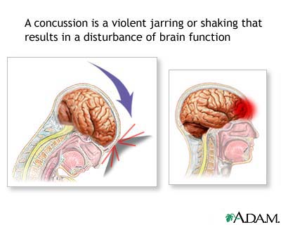 Concussion.jpg