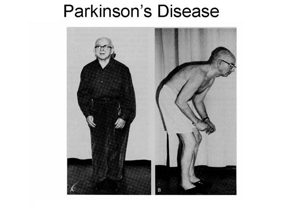 parkinsons-disease2.jpg