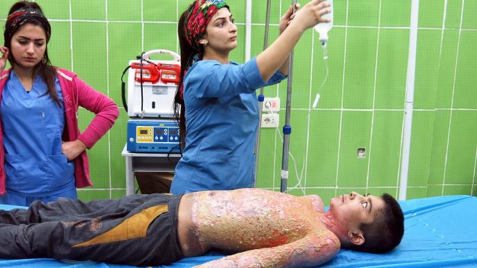 Mohammed, 13, had 12 hours of agony before his burns could be treated