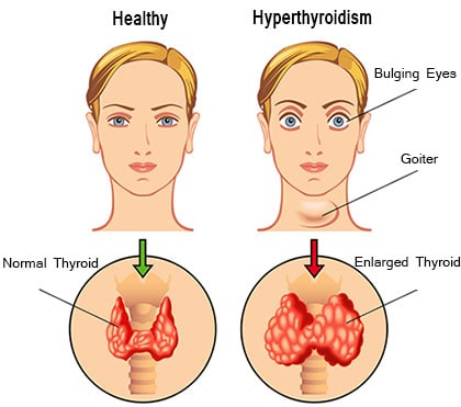 hyperthyroidism_2.jpeg